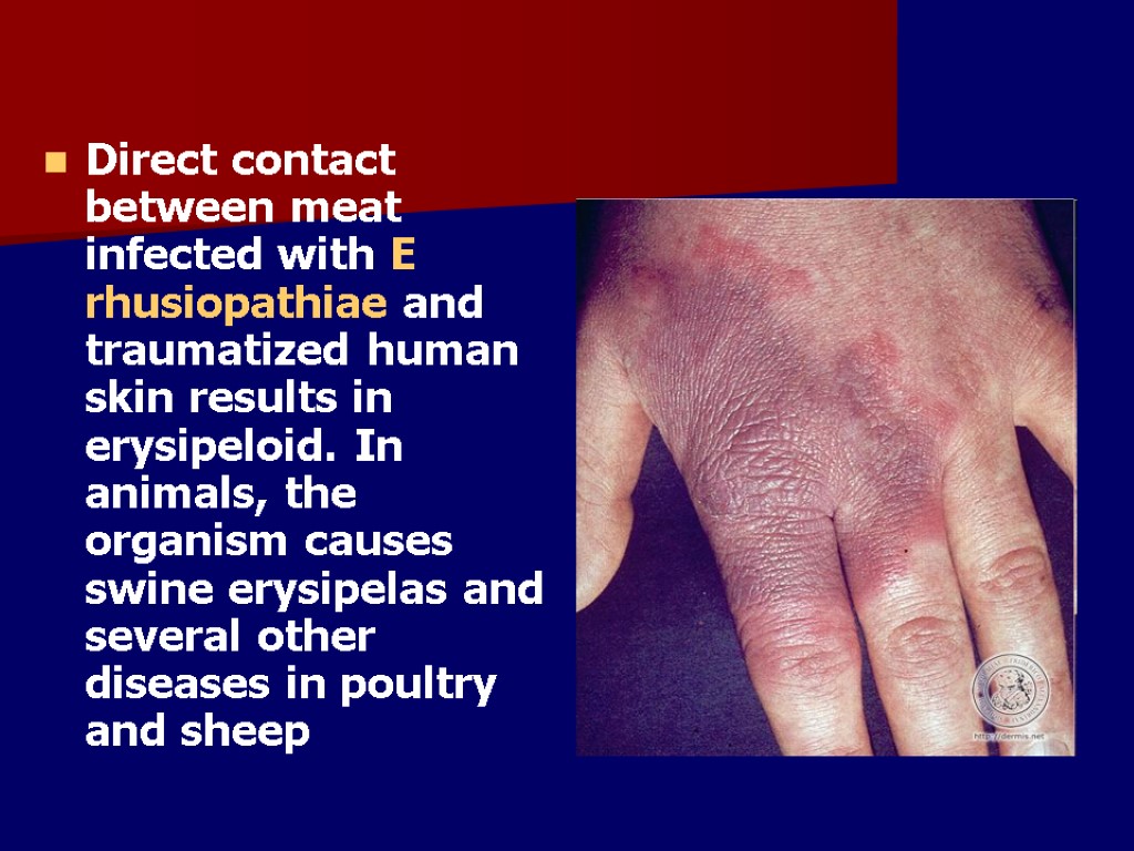 Direct contact between meat infected with E rhusiopathiae and traumatized human skin results in